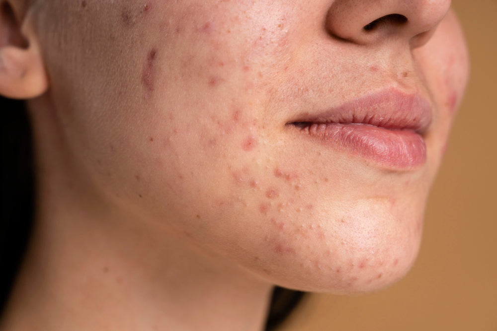 Integratori per acne: approccio nutrizionale alla salute della pelle